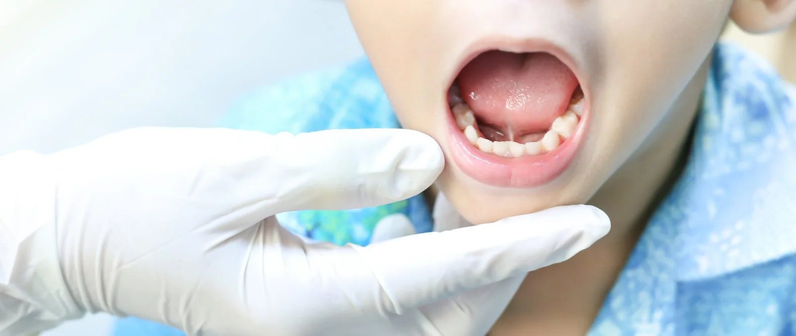 Tongue Tie Lip Tie Treatment